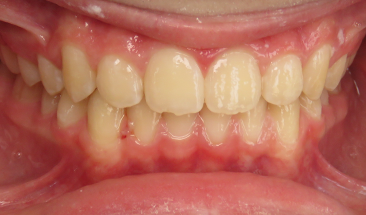 Image of crowding and deep bite after Invisalign - St. Paul, MN