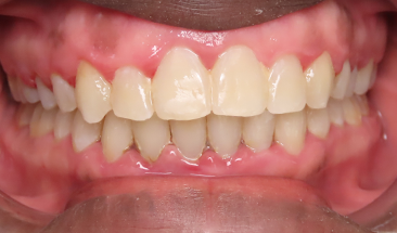Image of crowding and overbite after braces - Eagan, MN