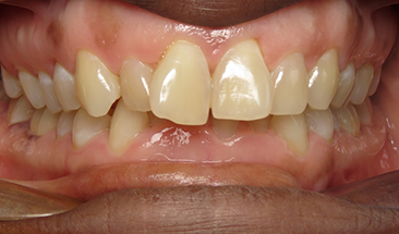Image of crowding and overbite before braces - Eagan, MN