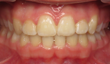 Images of deep bite and crowding after braces - Eagan, MN