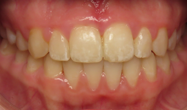 Image of overbite and crowding after braces - St. Paul, MN