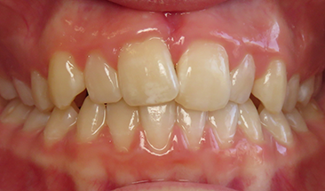 Image of overbite and crowding before braces - St. Paul, MN