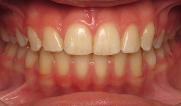 Image of deep bite and crowding after Invisalign treatment - Eagan & St. Paul, MN