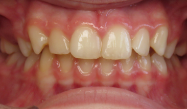 Image of deep bite and crowding before Invisalign treatment - Eagan & St. Paul, MN