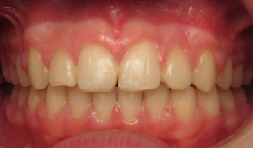 Images of over bite and crowding after braces - Eagan, MN