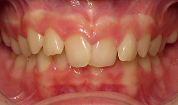 Images of over bite and crowding before braces - Eagan, MN