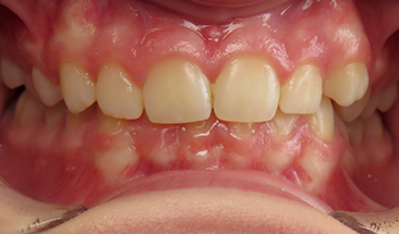 Image of deep bite and crowding before Invisalign - Eagan, MN
