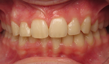 Image of overbite and crowding after braces - St. Paul, MN