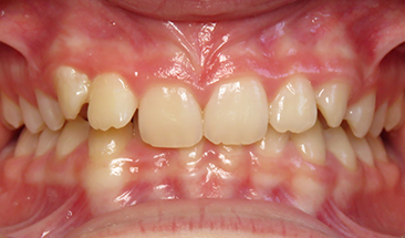 Image of overbite and crowding before braces - St. Paul, MN