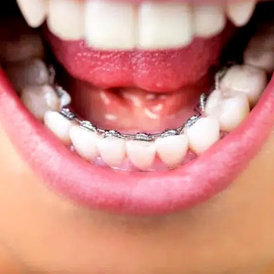 Image of Bonded Retainers | Lakeside Orthodontics - Eagan & St. Paul, MN